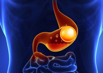 Obeziteye karşı mide  balonu iyi bir seçenek